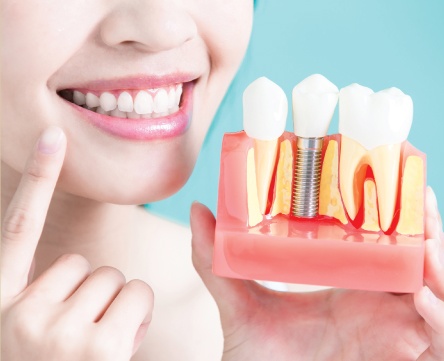 dental implant example