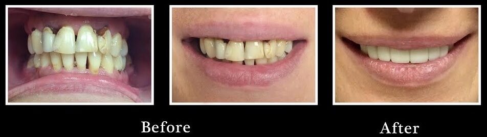 Dental Before and After the power of a smile