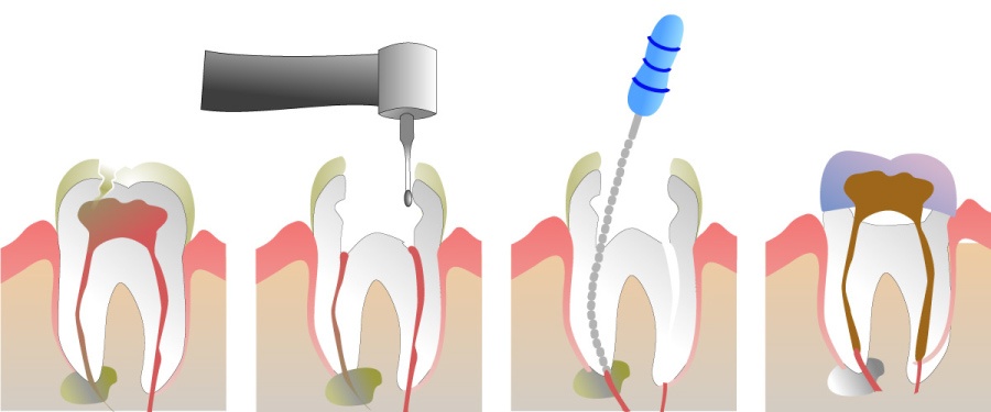 Graphic showing the steps of root canal therapy 