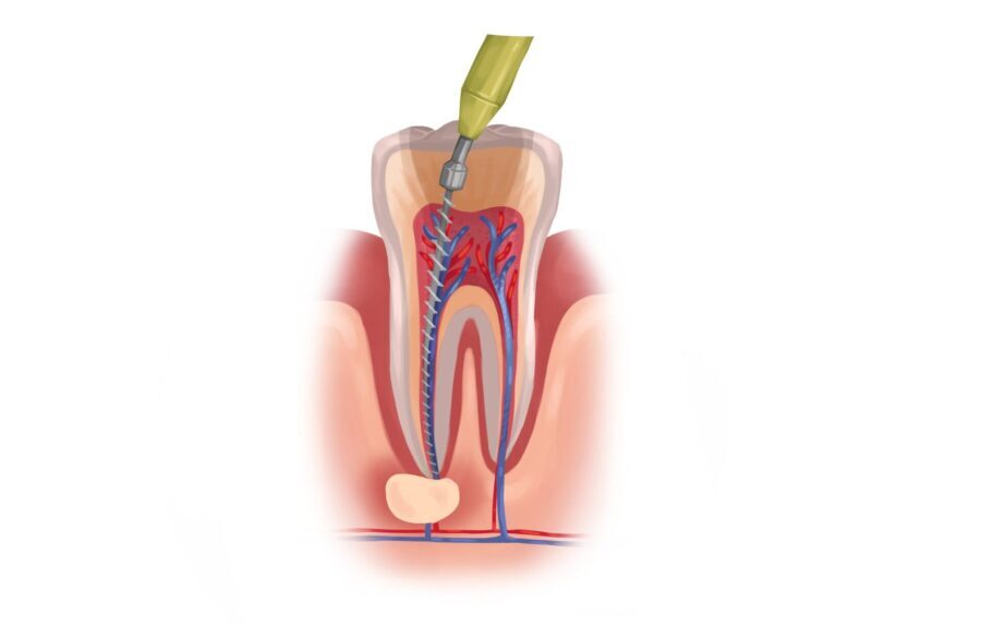 Illustration of a root canal treatment